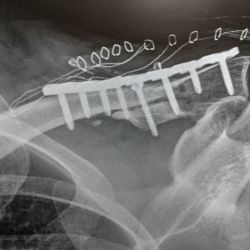 El mundial de ciclismo 2019 con Paco Franch, accidente en la Contador con Miguel Ángel Granero