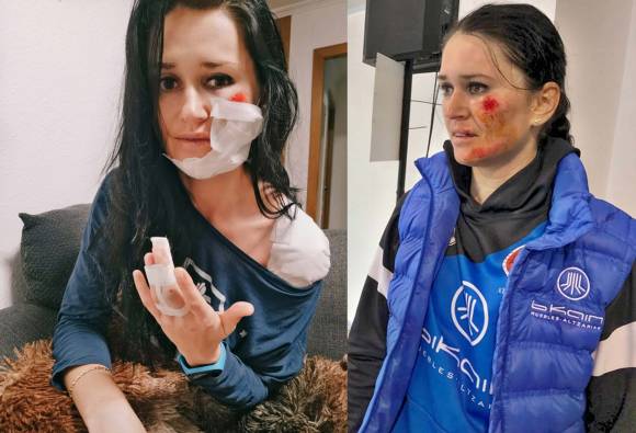 Raluca tras la caída